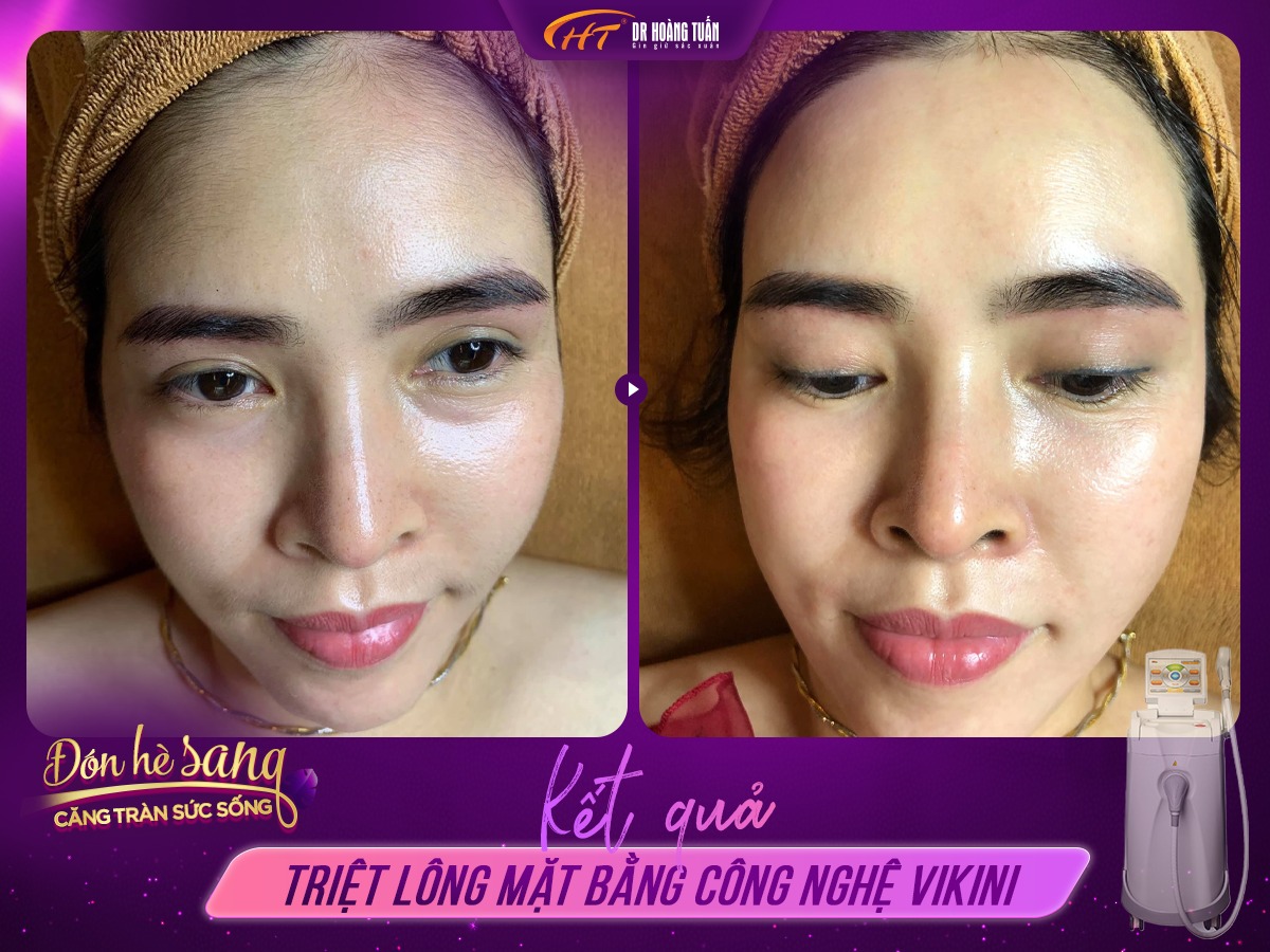 Triệt lông vĩnh viễn là gì?